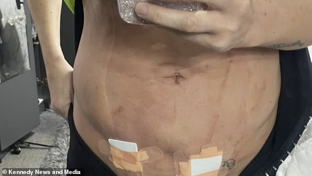 Not only did she suffer complications from the procedure but has also been left with an unsatisfactory 'lump' on her stomach