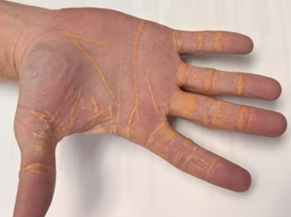 Hand with xanthelasma deposits after a high-fat diet.