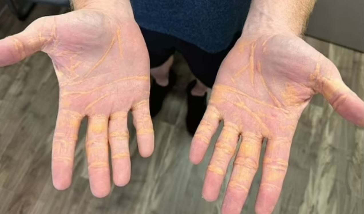 Hands showing xanthelasma, a sign of high cholesterol.