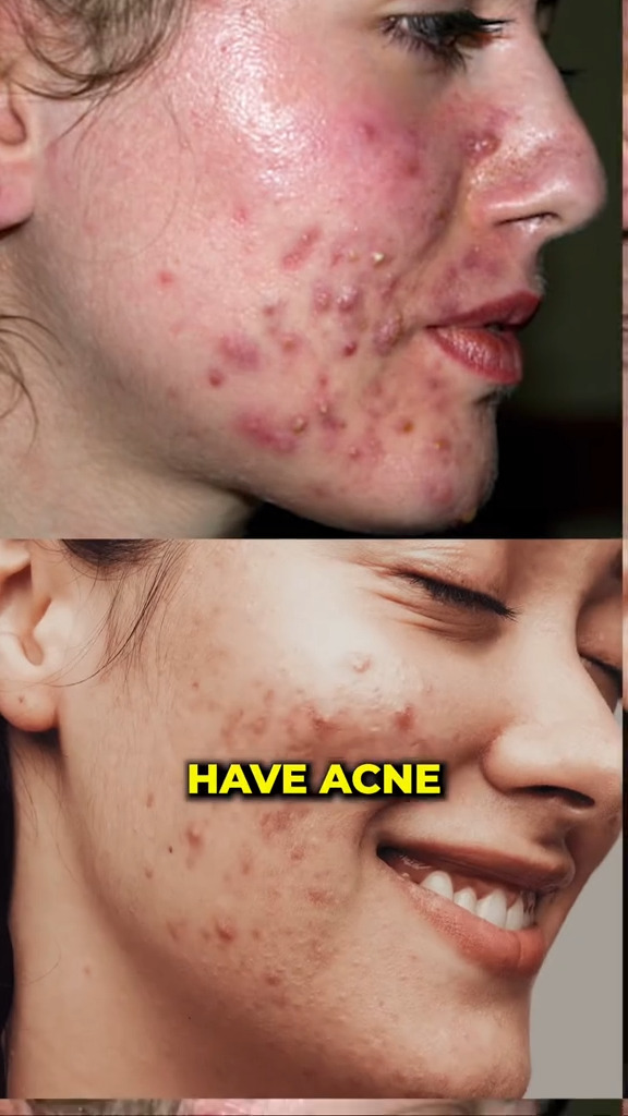 Before and after photos showing the effects of eliminating sugar on acne.